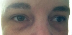 Allergy shiners due to sulphite sensitivity/intolerance.